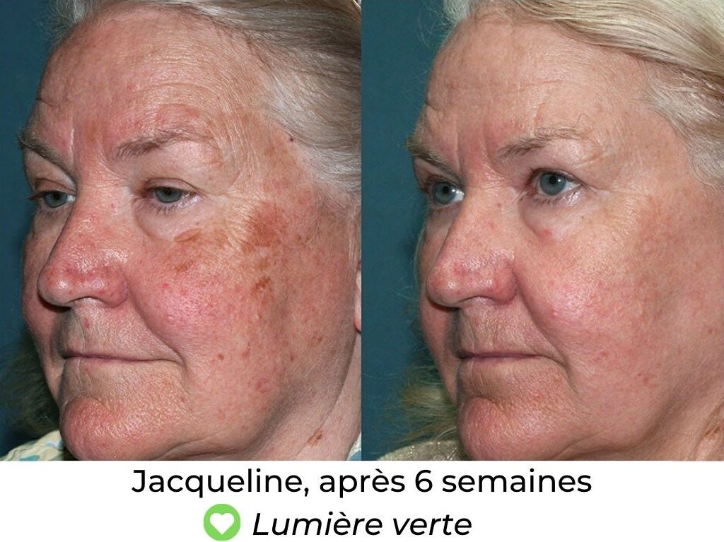 Masque LED Thérapeutique – Soin Visage Éclat et Rajeunissement