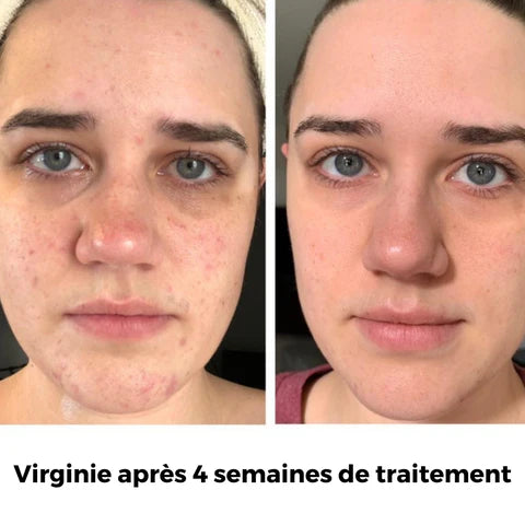 Masque LED Thérapeutique – Soin Visage Éclat et Rajeunissement